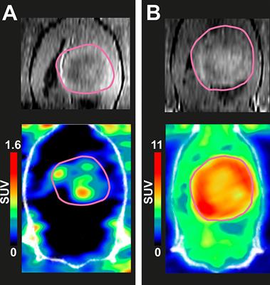 High folate receptor expression in gliomas can be detected in vivo using folate-based positron emission tomography with high tumor-to-brain uptake ratio divulging potential future targeting possibilities